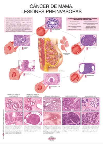 Cáncer de Mama. Lesiones Preinvasoras