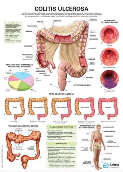 Colitis Ulcerosa