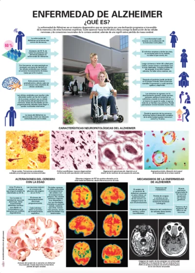 Enfermedad de Alzheimer. ¿Qué es?