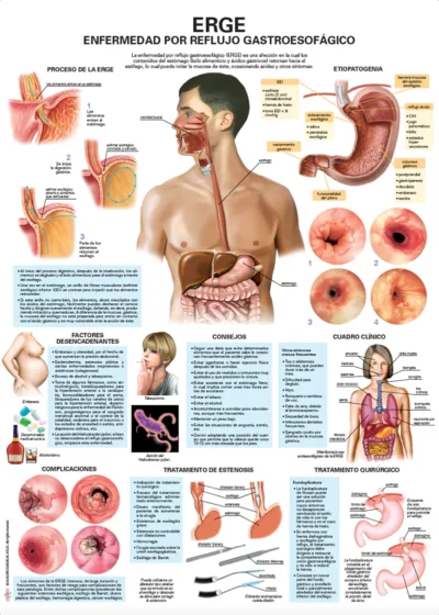 ERGE. Enfermedad por Reflujo Gastroesofágico
