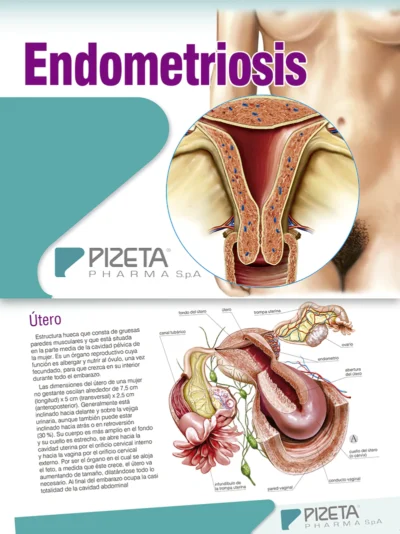 Endometriosis