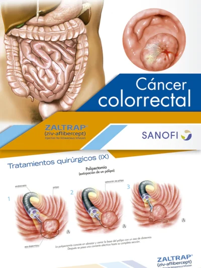 Cáncer Colorrectal