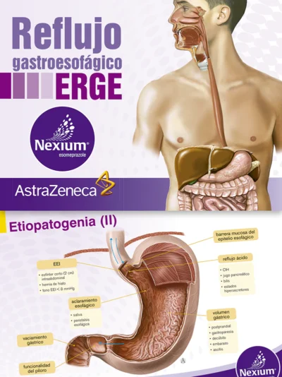 Reflujo Gastroesofágico ERGE