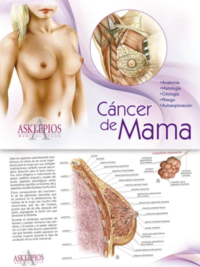 Cáncer de Mama