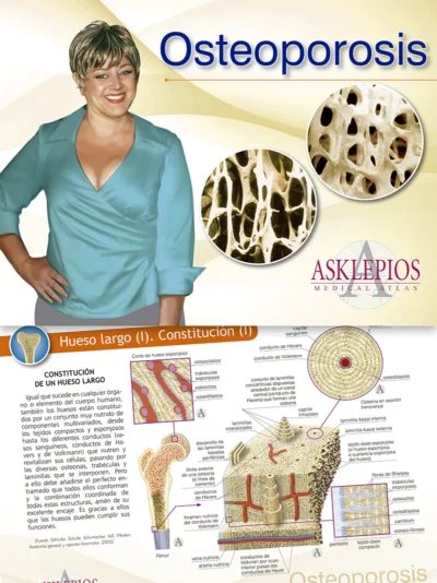 Osteoporosis