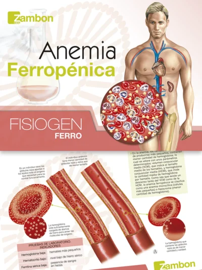 Anemia Ferropénica