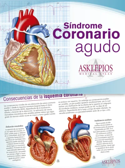 Síndrome Coronario Agudo