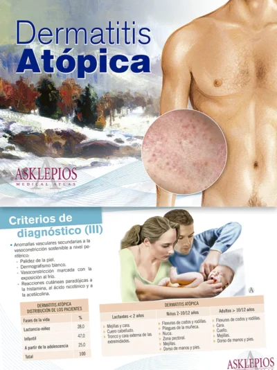 Dermatitia Atópica