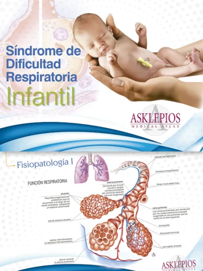 Síndrome de Dificultad Respiratoria Infantil