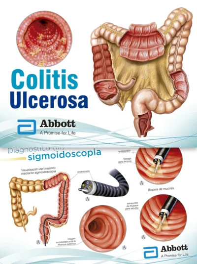 Colitis Ulcerosa