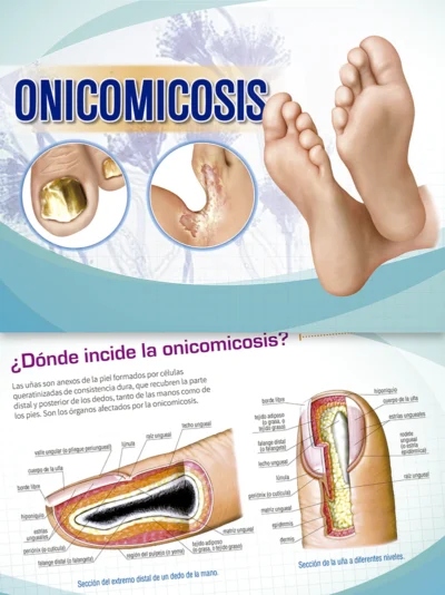 Onicomicosis