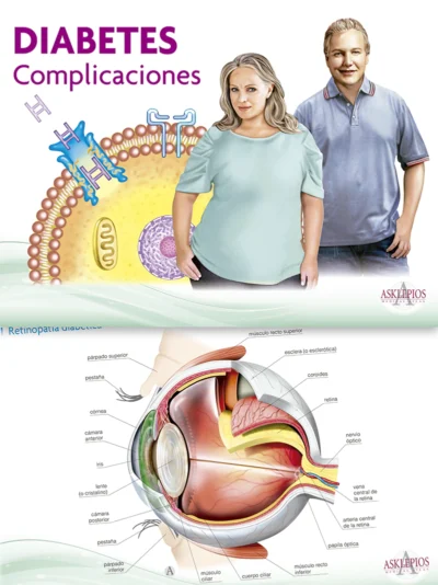 Diabetes. Complicaciones
