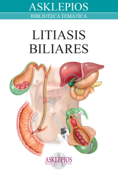 Litiasis Biliares