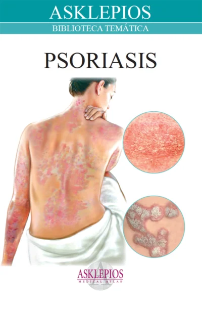 Psoriasis