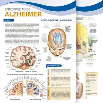 Enfermedad de Alzheimer