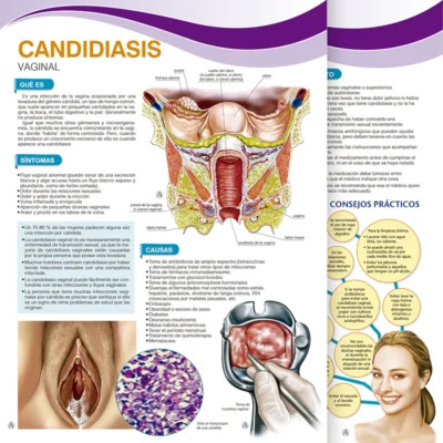 Candidiasis Vaginal