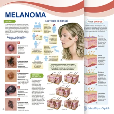 Melanoma