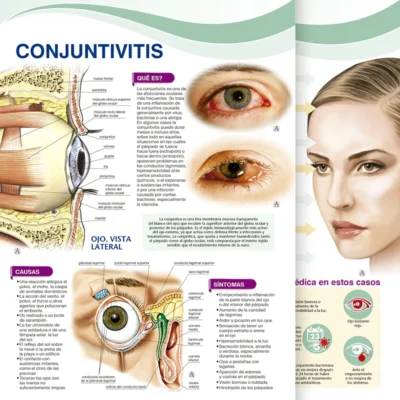 Conjuntivitis