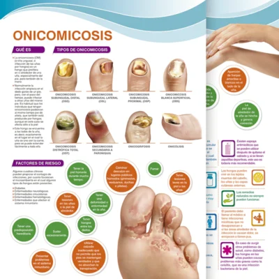 Onicomicosis