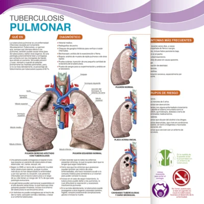 Tuberculosis Pulmonar