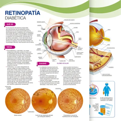 Retinopatía Diabética