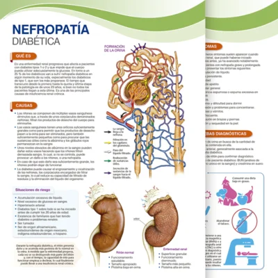 Nefropatía Diabética