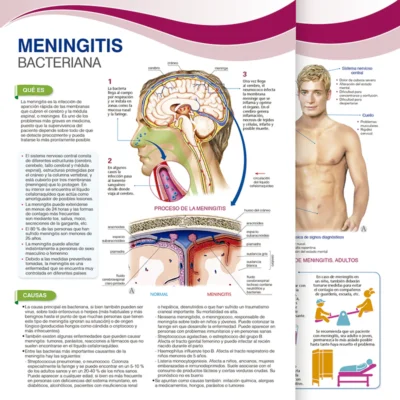 Meningitis Bacteriana