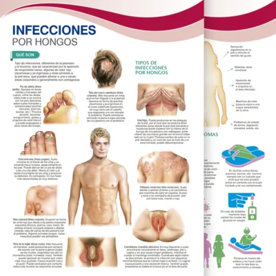 Infecciones por Hongos