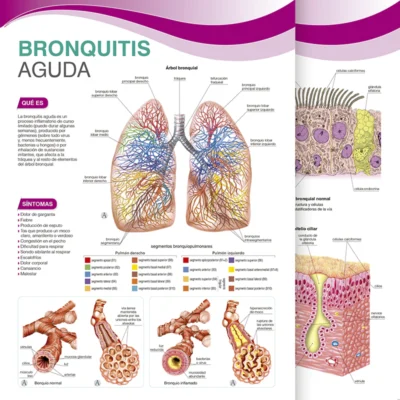 Bronquitis Aguda